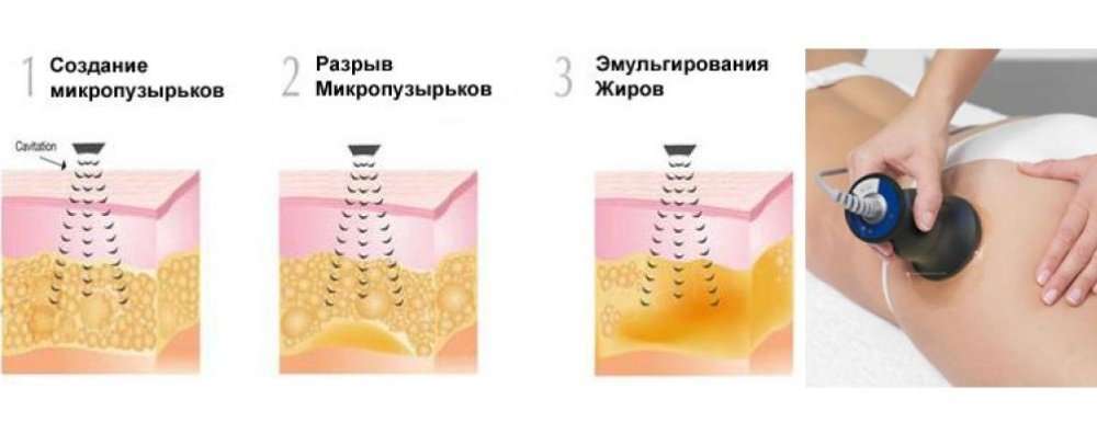 Вакуумный Массаж Живота Аппаратом Отзывы Фото